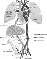 Image result for Delayed Transition from Fetal Circulation