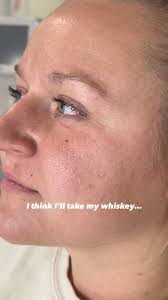 fresh lip transformation 💉💋 , before and afters like this are soooo  satisfying! , #reneuxaesthetics #rninjector #injectables #lipfiller  #beforeandafter #lipinjections #aestheticmedicine