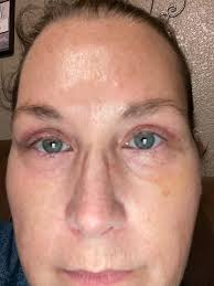 I'm debating whether to get the surgery, my eyes have always been hooded  but as I've aged (42) it's got worse, do you think I would be a good  candidate? I'm worried