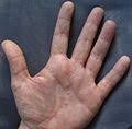 Dyshidrotic eczema is an ongoing (chronic) skin condition. Dyshidrosis Wikipedia