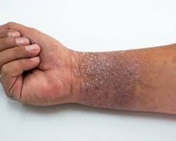 Image result for Atopic eczema atopic dermatitis