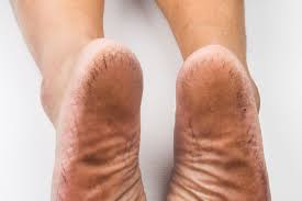 Cerita legenda itu diyakini masyarakat setempat hingga sekarang. Tumit Kaki Merekah Kadangkala Menyakitkan Ketika Berjalan June 2021 Kelabmama Malaysia