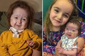 Girl, 2, is only person in the world to be diagnosed with rare form of Benjamin  Button disease