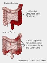 Colitis Ulcerosa Beschreibung Symptome Behandlung Netdoktor