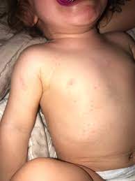 Ot Allergic Reaction To Azithromycin Hot Topics Forums What To Expect