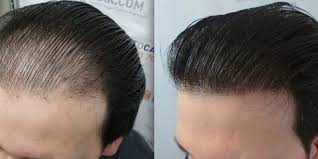 These include androgenetic alopecia, lichen planopilaris, telogen effluvium, and alopecia areata.key terms: The Best Hair Transplant Guide Hair Transplant By Samarth Sonawane Medium