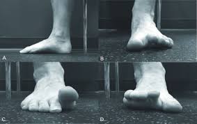 When Heel Pain Is Not Plantar Fasciitis Podiatry Today