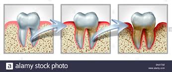 Periodontitis Stock Photos Periodontitis Stock Images Alamy