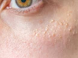 Bumps on face not acne. How To Get Rid Of Milia Causes Prevention And Removal