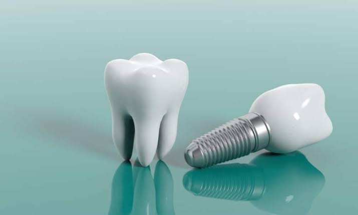 The Complete Guide To Understanding How Dental Implants Work