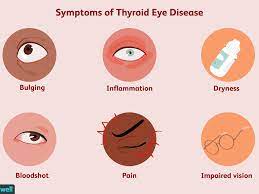 Graves' disease is an immune system disorder that results in the overproduction of thyroid hormones (hyperthyroidism). Thyroid Eye Disease Symptoms Causes Diagnosis And Treatment