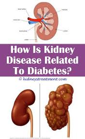 Kidney Stones Sizes Kidney Disease Symptoms Polycystic Kidney Disease Kidney Disease Stages