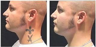 The process of fully removing tattoos will require a doctor's help. Tattoo Removal Kootenay Medical Centre
