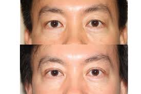 Both men and women with moderate to severe frown lines may benefit from a botox brow lift. Before And After Asian Double Eyelid Surgery Dr Andrew B Denton