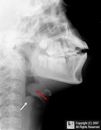 Image result for Epiglottitis