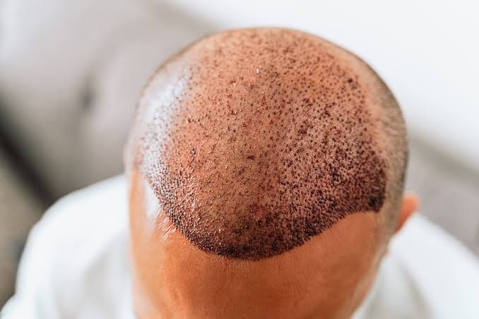 The Hair Transplant No One Will Know You Got | Miami Hair