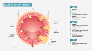 Image result for Bladder Cancer Staging