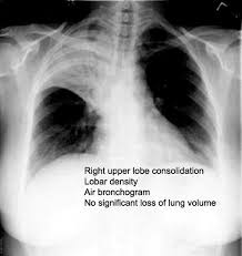 Image result for Air Bronchogram