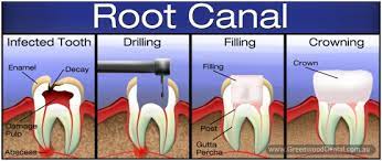 No, you don't get the crown on the same day as the root canal. Jr Dental Practice Dentist In Sevenoaks Kent Root Canal Treatment