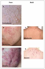 management of acne canadian clinical practice guideline cmaj