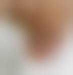 Image result for Acral lentiginous melanoma nail