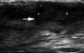 An ingrown underarm hair may cause you a lot of problems. Inflamed Hair Follicle A Ultrasound Transverse View Follicular Download Scientific Diagram