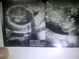 Hasil usg kehamilan 5 minggu yang normal. Perbedaan Usg Jk Lakilaki Dan Perempuan 14 Week Mohon Masukannya Ya Bun Ibuhamil Com