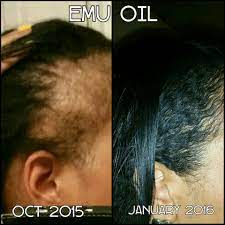 But this mixture may cause itching, dryness, and poor scalp penetration. Emu Oil Benefits Help Hair Growth Emu Oil Hair Hair Loss Solutions