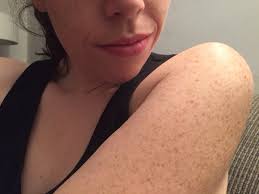 Robin berzin, md of parsley health explains what causes the skin condition. I Have Red Bumps On My Upper Arms Help Hannah Sowd Skin Care