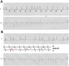 Image result for Extrasystole