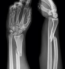 Image result for Forearm Fracture