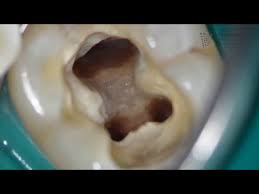 » wurzelbehandlungen kommen bei durch bakterien infizierten zähnen zum einsatz, vorwiegend bei befall des zahnmarks. Was Ist Eine Wurzelbehandlung Faq Fur Patienten