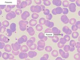 Image result for Peripheral Smear