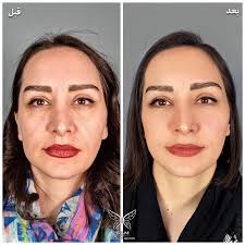 عکسهای قبل و بعد از لیفت صورت با نخ کاگ - کلینیک زیبایی سام