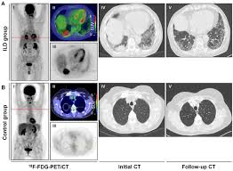 If cancer has spread to these areas, it will not show on a ct scan. Impact Of Fdg Pet On The Detection Of Patients With Lung Cancer At High Risk For Ild In Vivo