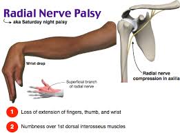 This Patient Presents With Findings Consistent With A Radial Nerve Palsy The Radial Nerve Is Formed From Nerve Roots Nerve Palsy Radial Nerve Medical Anatomy