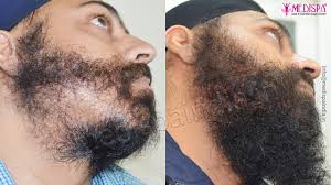 The estimated facial hair transplant cost in dubai starts from aed 15000. Beard Transplant Beard Transplant Procedure Results