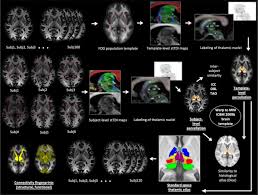 In Vivo Super Resolution Track Density Imaging For Thalamic Nuclei Identification Biorxiv