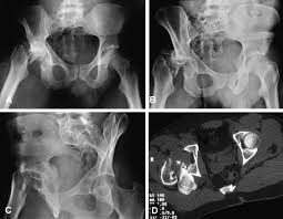 We did not find results for: Hip Dislocation And Femoral Neck Fracture Decision Making For Head Preservation Injury
