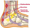 Inflammation tendon mollet