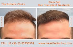 Researchers have identified the biological mechanism of how chronic stress leads to hair loss. Stem Cells Treatment Mumbai Stem Cells Therapy Cost India The Esthetic Clinics