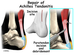 By strengthening the achilles tendon in the same manner as a running or sprinting motion, you will help prevent the achilles injury from coming back. Achilles Tendonitis And Achilles Tendon Rupture Orthogate