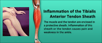 Pin By Ronda Dickey On Fitness Leg Injury Ankle Surgery Ankle Injury