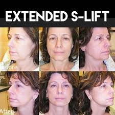 Here you may to know how to lift saggy jowls. Aesthetic Surgical Arts Naturally Improve Sagging Jowls And Neckline With Minimal Recovery Time 10 Off S Lifts Booked In February But Can Be Scheduled Into May 2019 One Week Left For Our