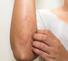 Wat gebeur, is bloot dat die immuunstelsel foutiewe seine uitstuur wat die groei van 'n lyer se velselle laat versnel. Psoriase Dra Isy Peixoto