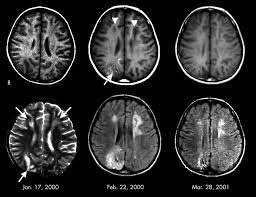 Maybe you would like to learn more about one of these? Guillain Barre Syndrome Associated With Central Nervous System Lesions Archives Of Disease In Childhood