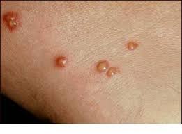 Vezicule pline cu lichid pe degetele de la mâini, de la picioare, pe palme și pe tălpi. Poze Medicale Veziculele Leziuni Tegumentare Cu Continut Lichid Basica Cu Lichid