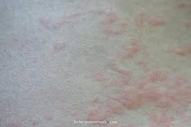 Acute urticaria and/or angioedema are hives or swelling lasting less than 6 weeks. Hatekony Modszerek A Csalankiutes Megszabadulasara