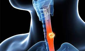 Can Gastric Problems Cause Chest Pain Health Plus