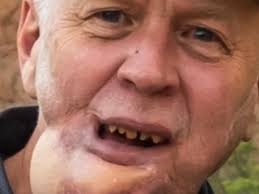 Fundraiser by Josanne Mcafee : Help Bruce Mcafee get implants after mouth  Cancer